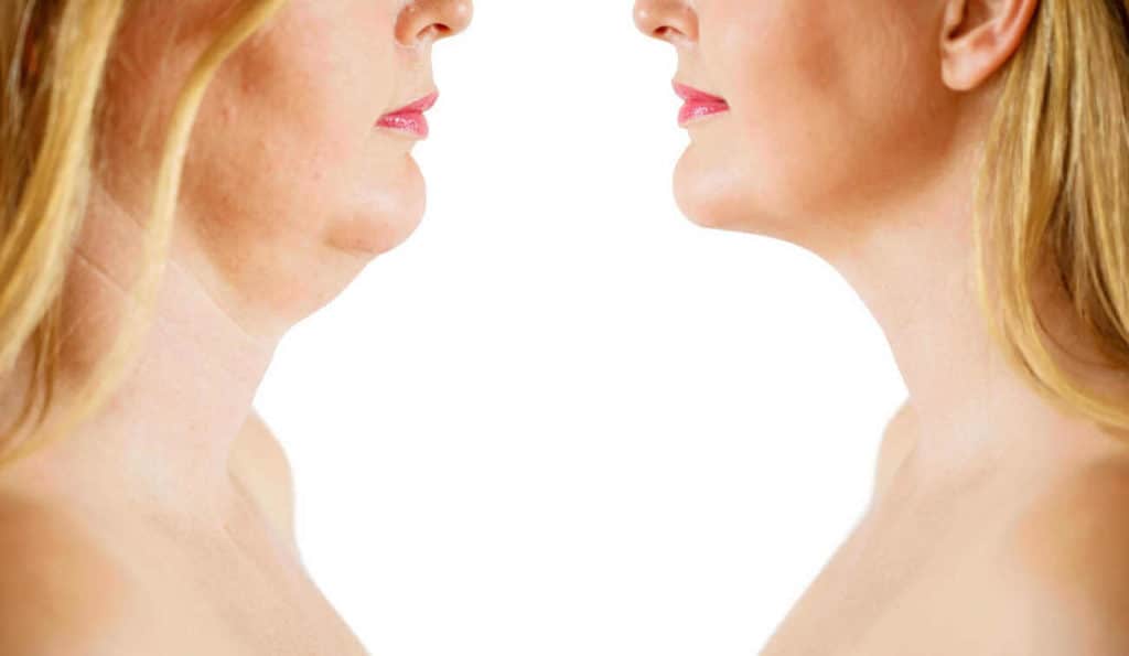 Double Chin treatment Thame before and after results