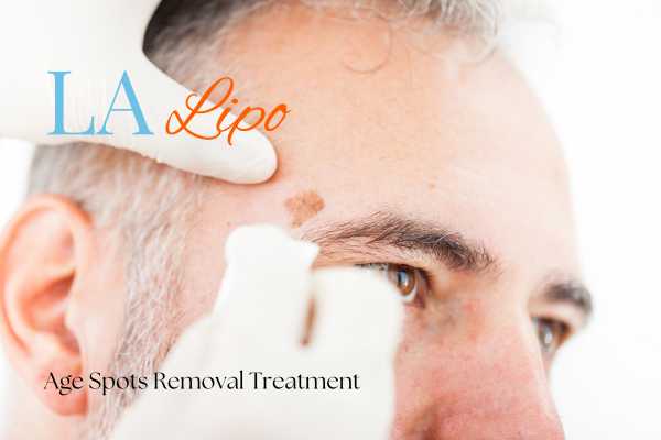 What Are the Most Effective Treatments for Age Spots Thame?