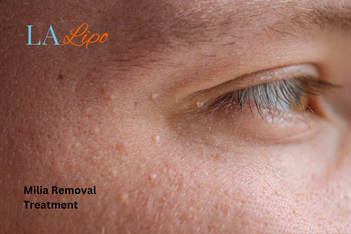 Cryopen Milia Removal: Is It the Easiest and Safest Option Thame?