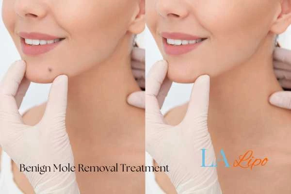 woman's before and after mole removal Thame results