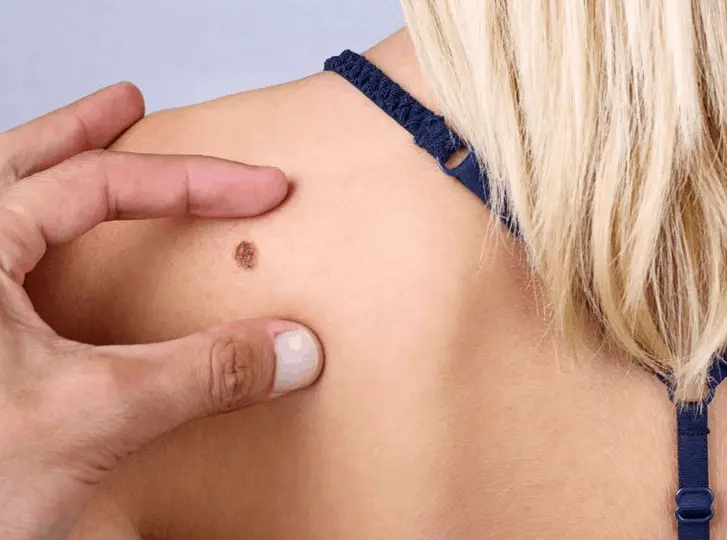 woman having mole removal Thame consultation before treatment.