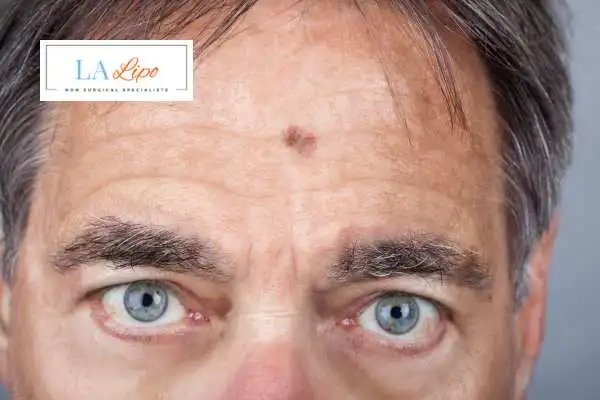 Solar Lentigo Removal Thame image of man with mark on his forehead