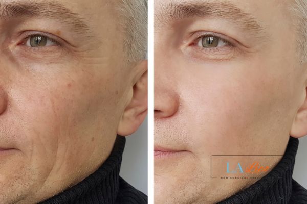 See the amazing results of Morpheus8 Treatment Thame!
