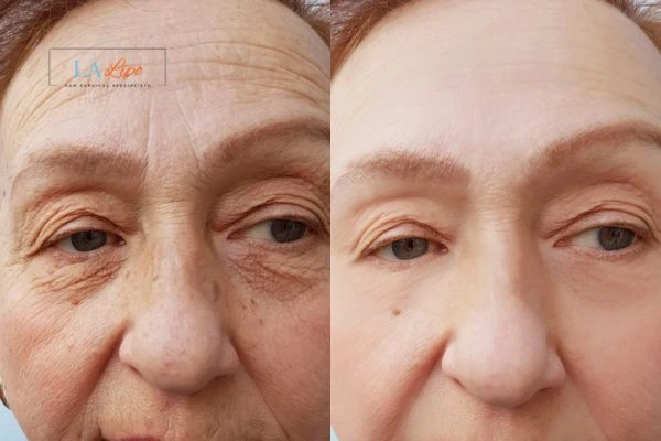 The powerful benefits of Morpheus8 Treatment Thame - Call Our team today!
