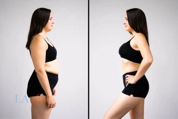 Picture of womans before and after using LA-EMS body sculpting to improve her core strength Thame