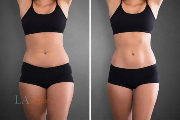 before and after results of non-surgical treatment to help a woman's body image and mental health Thame