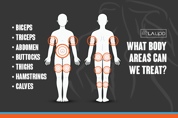 Diagram to show areas you can have LA-EMS Body Sculpting Treatment Thame