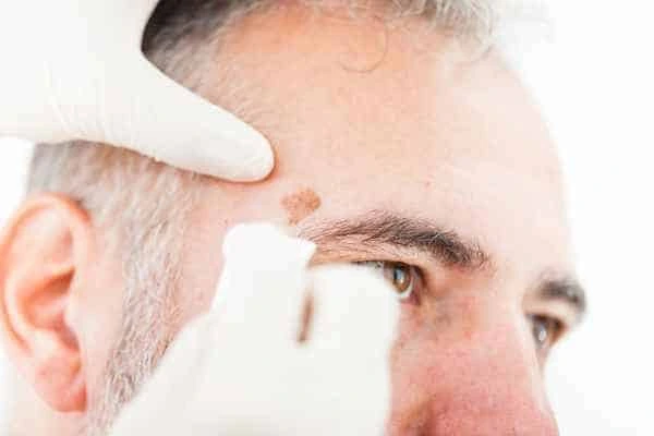 Age spots and elderly people Thame what is the link?
