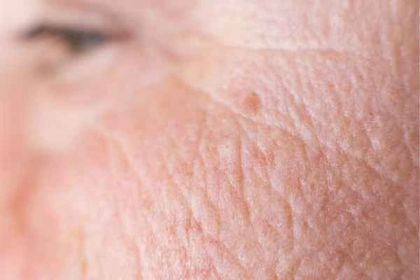 close up picture of a woman's face showing an age spot Thame