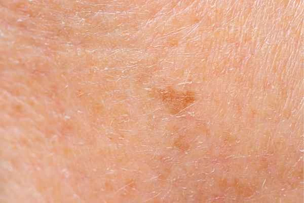 close up picture of age spots Thame