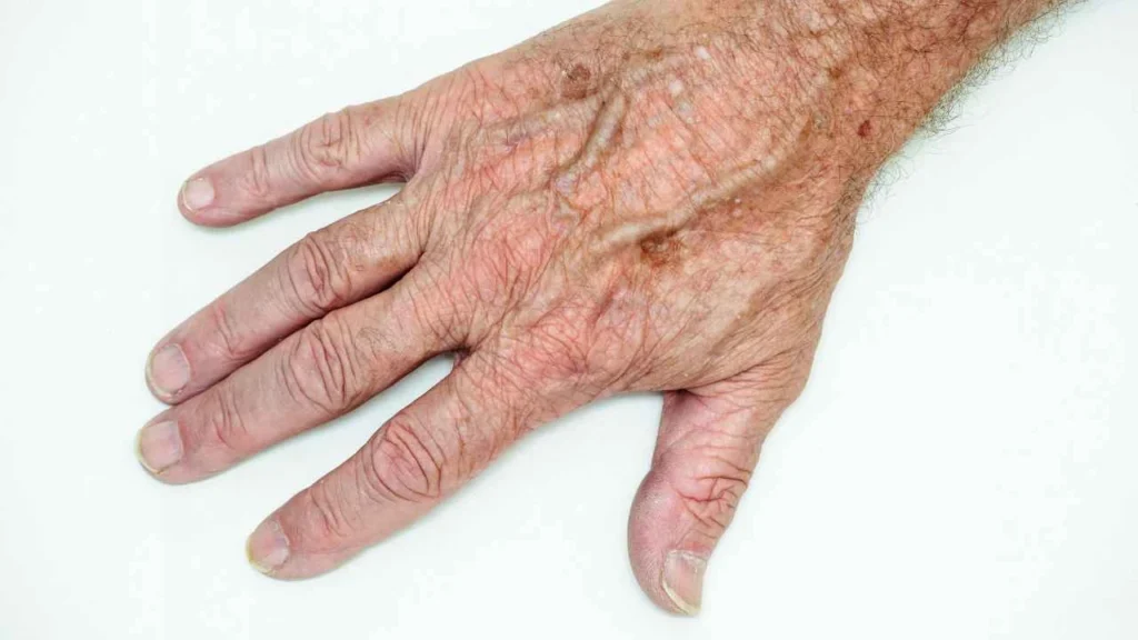 Male hand showing age spot Thame
