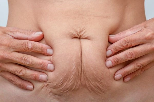 Image of a woman's stomach with loose skin - example of skin tightening Thame options