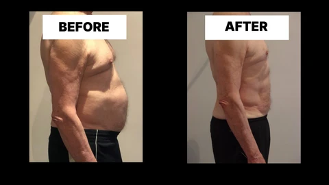 What Symptoms Can Diastasis Recti Cause in Men? Weak Core, Back Pain and Poor Posture Thame